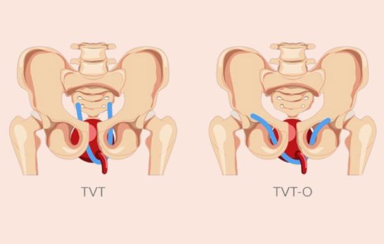 Tension-free Vaginal Tape (TVT) und Transobturator Tape (TOT)